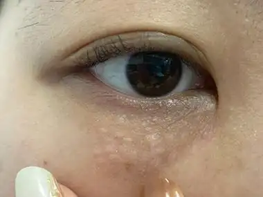 汗管瘤眼睑白色丘疹颗粒图
