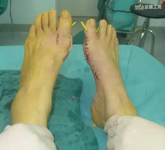 akin截骨术在拇外翻手术中的应用学组专辑