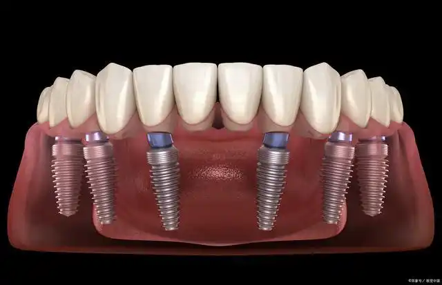 种植牙究竟种一颗得几个?