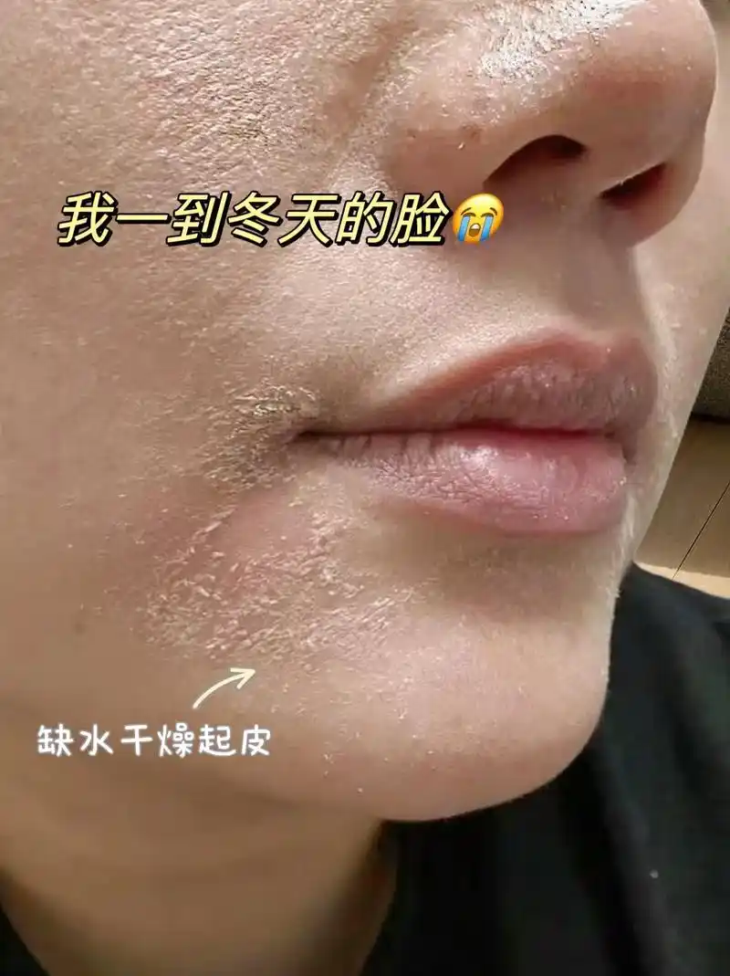 面膜你选对了吗?秋冬季节皮肤容易干燥起皮 - 抖音