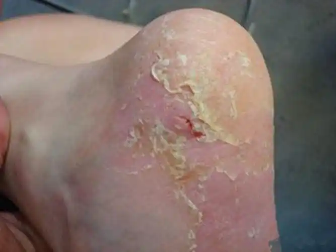 孕妇疥疮初期腹部皮肤症状图片