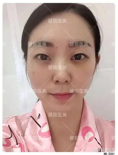 终于鼓起勇气去掉眼袋泪沟15天后效果