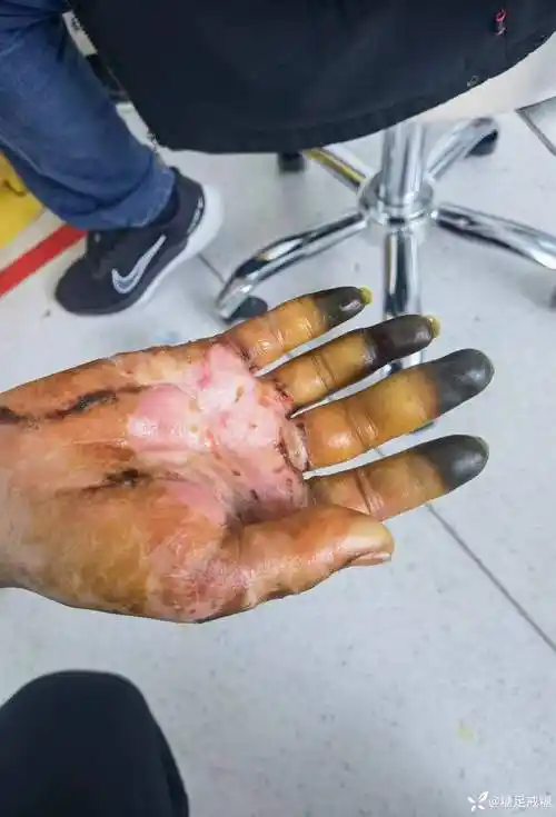 这种烫伤你见过吗
