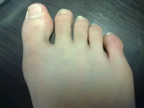 小脚趾骨头突出