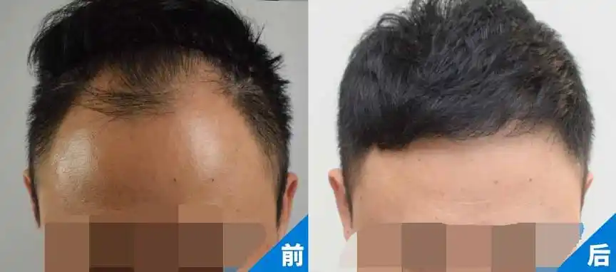 04,植发前后对比