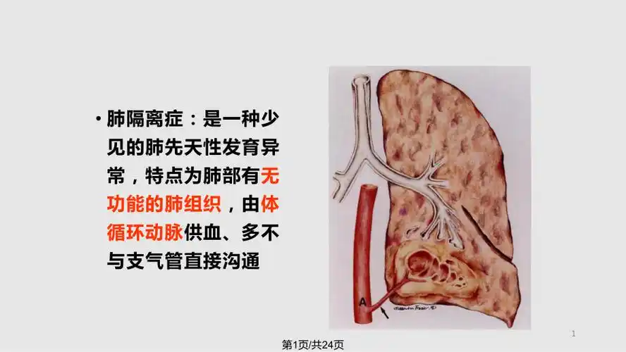 肺隔离症的影像表现ppt课件