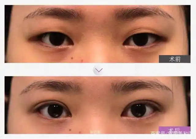 双眼皮手术前后对比