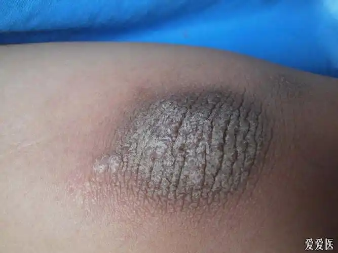 皮肤及性传播疾病讨论版 - 爱爱医医学论坛
