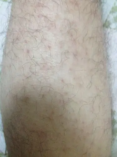 分享到:  2013-11-25 00:15提问者采纳 轻微毛囊炎,平时