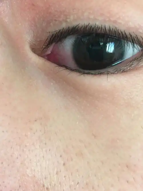 眼角有个白点怎么办?