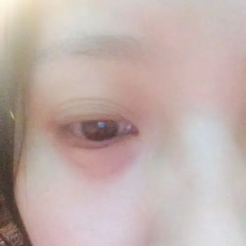 眼睛眼袋位置突然长个大水泡怎么回事就是这样的,我没眼袋只是黑眼圈