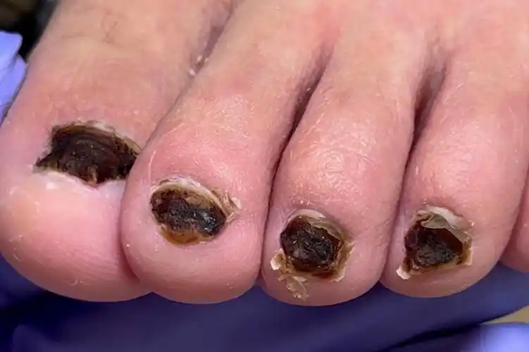 指甲被细菌感染,整个指甲被彻底去除