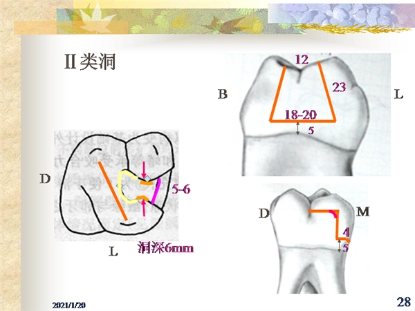 石膏牙Ⅱ,Ⅲ,Ⅴ类洞的制备