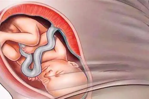 临近产期胎儿"入盆",孕妈会有这些感觉,快来对照下,你有吗?