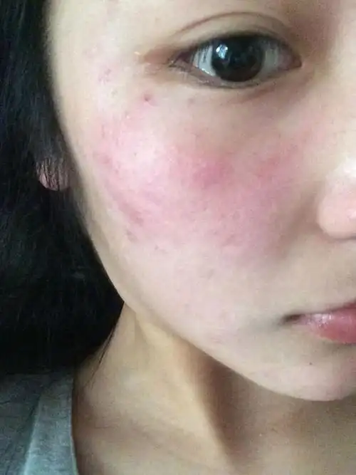 好烦啊,化妆品过敏,不知道该怎么办,红肿而且痒