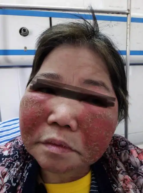 面部反复过敏样溃疡病例 [病例帖]