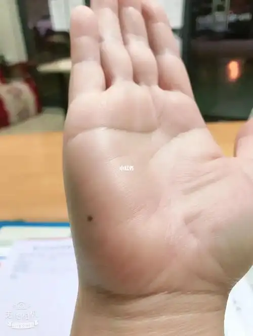 右手有颗痣代表失去爱我的人