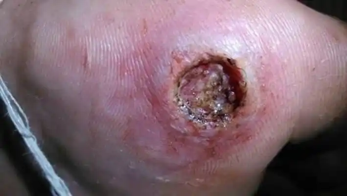 鸡眼根部挖出图片 (9)