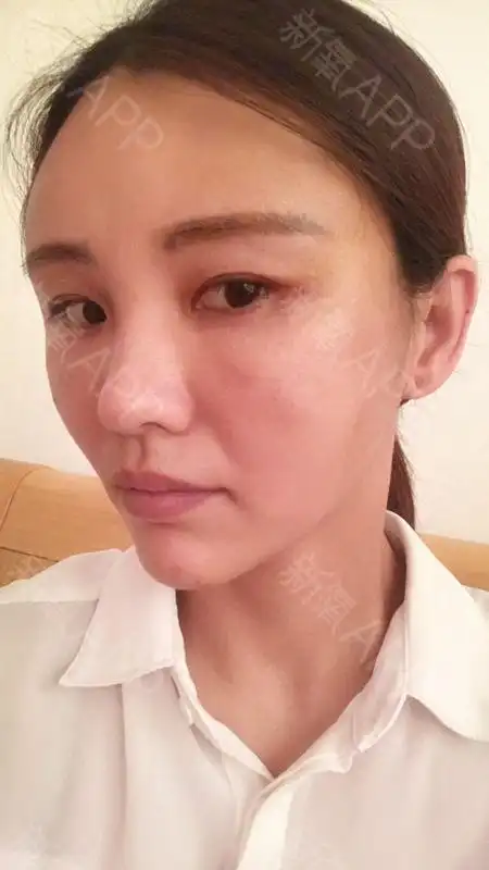 新氧- 沉淀的坚强枚 | 自体脂肪填充全脸 | 术后当自强 | 杭州同城