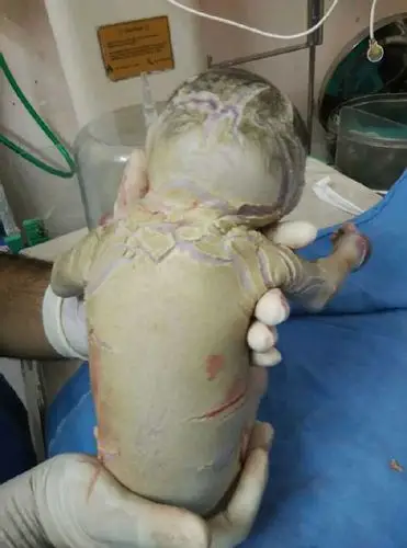 最后他们将宝宝的身体捐给罕见疾病研究机构,希望研究人员能够尽早