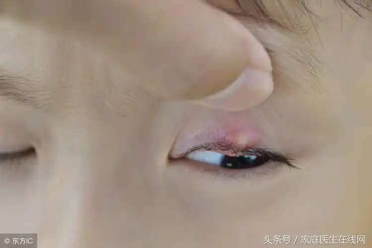 麦粒肿是上火引起的吗(眼睛长麦粒肿会自愈吗) - 好技术常识经验网