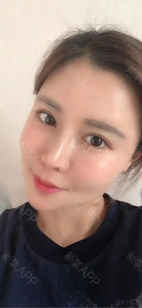 莉姐儿自体脂肪全脸填充第15天美丽日记