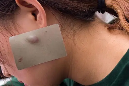 身上长小肉瘤是怎么回事