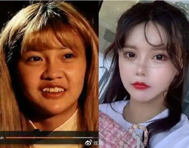 网红正妹自爆16岁起整型33次!