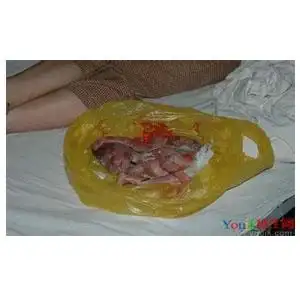 > 人流胎儿图 上一个下一个