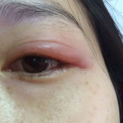 孕3个月左眼尾眼皮长个麦粒肿,一开始疼不太肿热敷后第二天又肿了今天