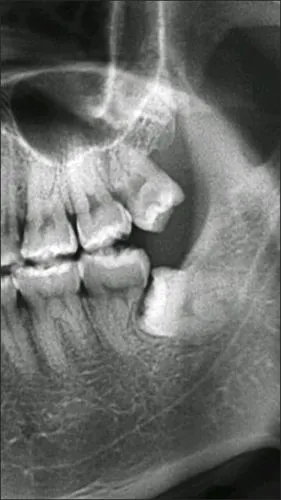 第二磨牙还能保得住吗?