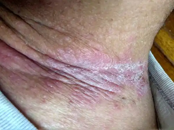 求助!老人脖子皮肤上怎么了 请见图