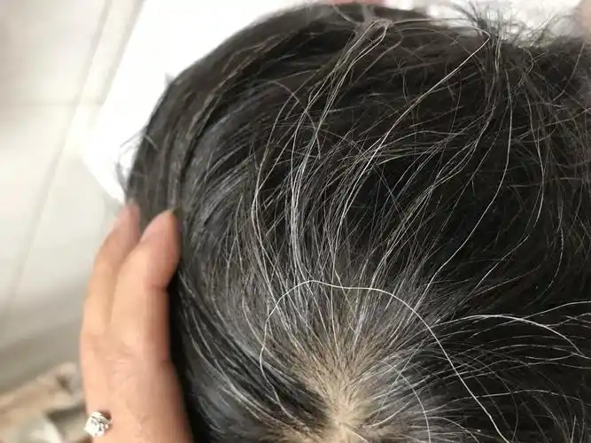 小孩子从两岁左右开始有白头发现在10岁越来越多也去