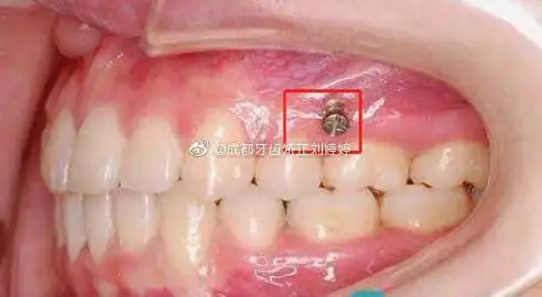 其实真的不见得很痛,因为首先医生在打骨钉之前,会先涂抹麻药,再打一