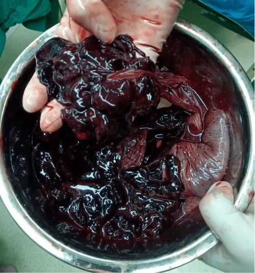 妈妈宫内出血,宝宝命悬一线,又是这个致命杀手_孕妇_胎盘_新生儿