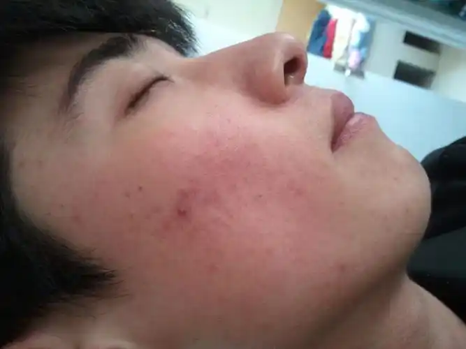 您好我是男生18岁 我是油性敏感皮肤 一年前脸一直红还有痘印类似的