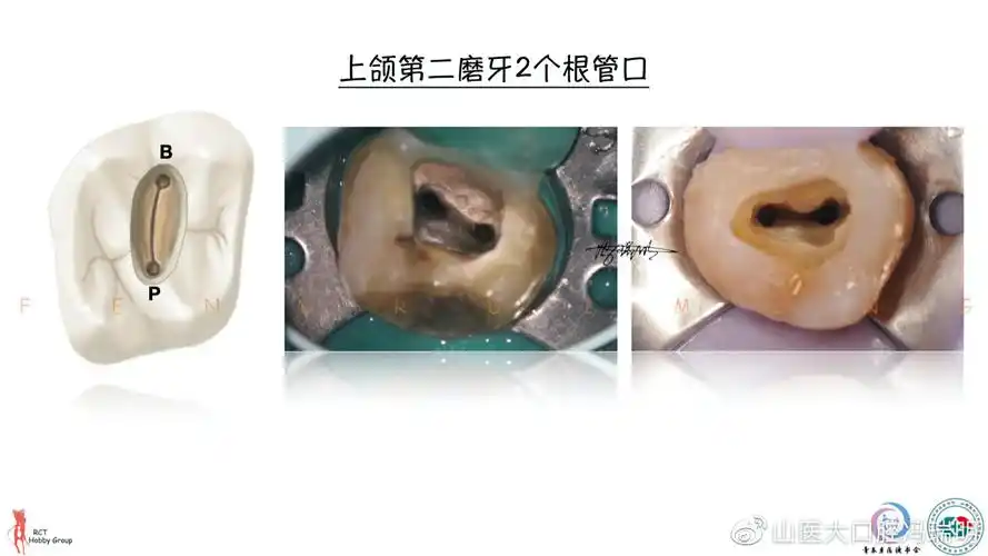 上颌第二磨牙根管解剖形态特点及病例分享