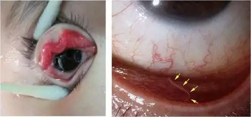 施妙手,97岁老汉眼睛里5条活虫被取出