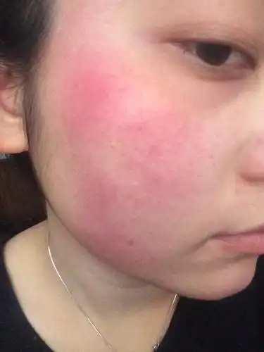脸上红血丝明显,不少,经常红烫,有时候一大早起来就烫,但是只烫半边