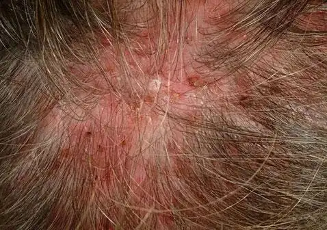 头皮毛囊炎图片和症状图片