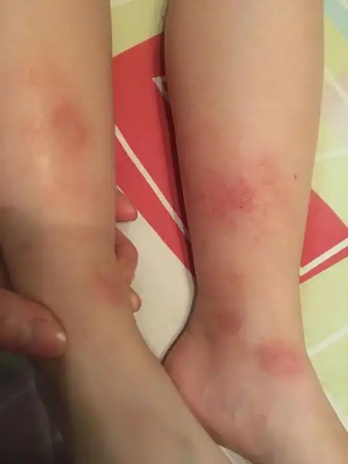 4岁宝宝腿上长癣怎么办,而且比较严重