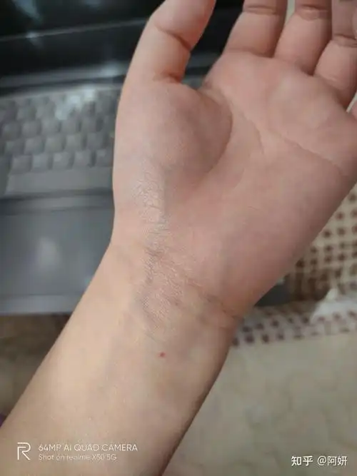 有人有这颗痣吗右手手腕