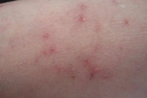 毛囊炎的早期症状图片