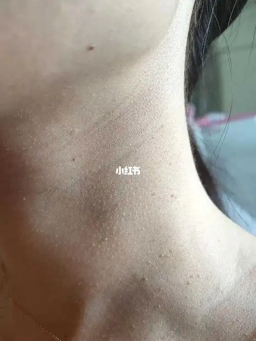 扁平疣不会治不好的,看看我的经历就知道