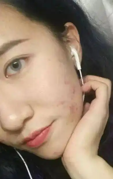 直男,怎么看待五官漂亮但皮肤差的女生?