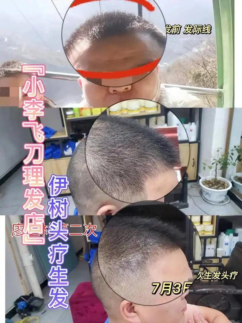 防脱生发一定要趁早