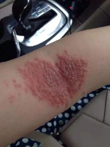 你们的湿疹能有我严重吗?从惨不忍睹要基本痊愈全纪录