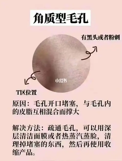 不同类型毛孔粗大和改善小方法