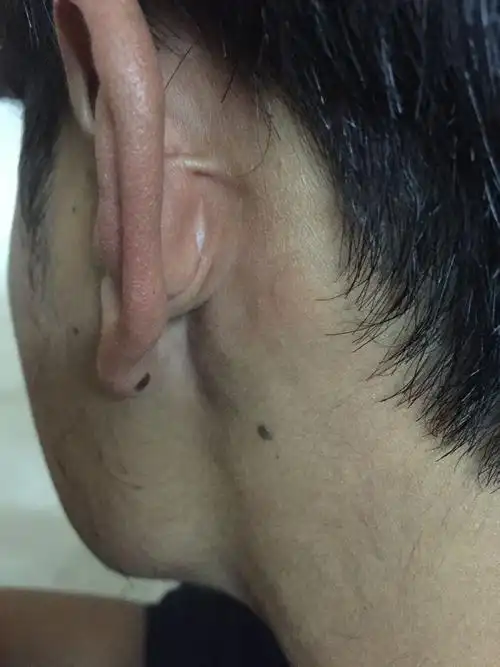 耳垂后面长了个痣是好还是坏?还有耳朵后面长了个瘊,这都好不好啊?