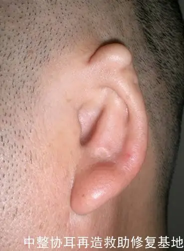 主页 爱耳科普 耳畸形病因    小耳畸形(就是小耳朵的意思),小耳畸形